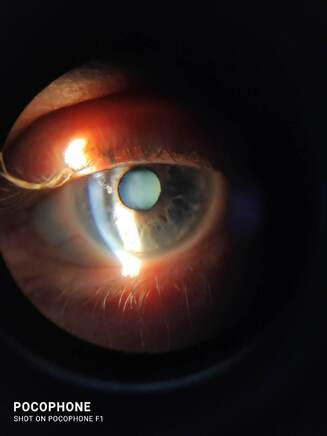 Pseudoexfoliationsssyndrom: ein grosses Augenproblem