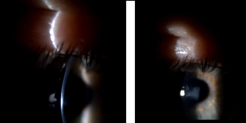 Keratoconus eye on the slit lamp. we can recognise the corneal thinning while on the right one the corneal scarring.