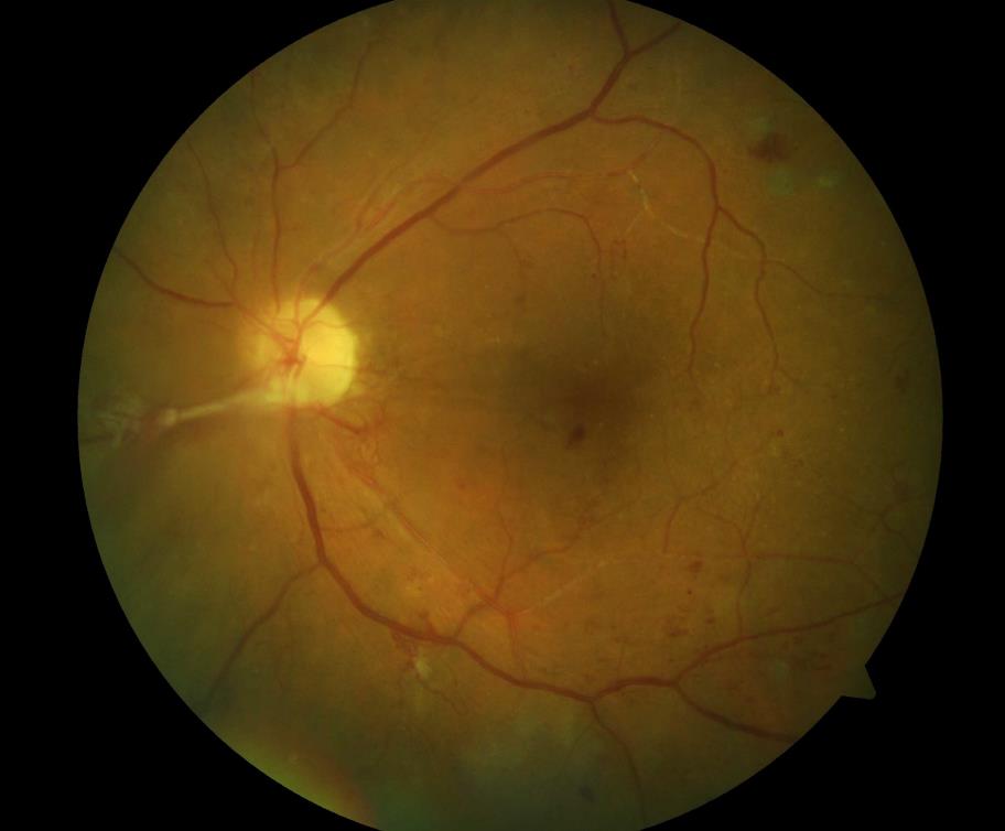 proliferative diabetic retinopathy with new vessels on the optic disc