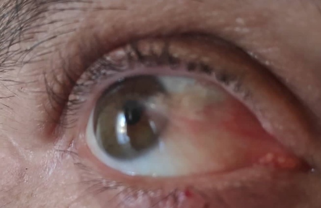 Was ist das Augenpterygium/Fluegelfell?